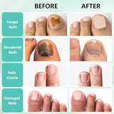 XIFEPFR Toenail Repair Treatment Extra Strength, Toenail Fûngus Treatment for Toenail and Fingernail, Nail Care Renewal Liquid for Thick Brittle Damaged Discolored Nails, Restoring Healthy Nails