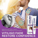 Vitiligo Cream, Vitiligo Treatment Cream, Vitiligo Cream for Skin Healthy Care