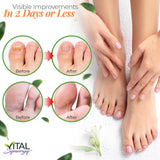 Vital Synergy Natural Tea Tree Oil Toenail Nail Repair Solution - Nail Treatment for Toenail & Fingernail Nail Repair - Athletes Foot Treatment - Extra Strength Damaged Nails Toe Nail Growth Treatment