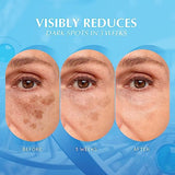 Dark Spot Remover for Face and Body: Natural Formula Dark Spot Corrector - Melasma Freckle Sun Spot Age Spot Brown Spot Remover - Niacinamide Serum for Women and Men