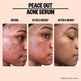 Peace Out Skincare Acne Serum. Daily Multi-Benefit Face Serum with 2% Salicylic Acid to Target Pimples, Zits, Blemishes and Breakouts, For Clearer-Looking Skin (1 fl oz)