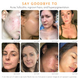 Face & Body Clearing Serum, Level 1-4 Fl Oz- For acne, folliculitis, aging skin, ingrown hairs, dark spots - mandelic acid