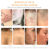 Face & Body Clearing Serum, Level 1-4 Fl Oz- For acne, folliculitis, aging skin, ingrown hairs, dark spots - mandelic acid